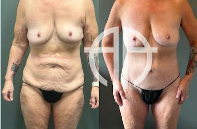 LIPOSUCTION Before & After Gallery - Patient 281568 - Image 1