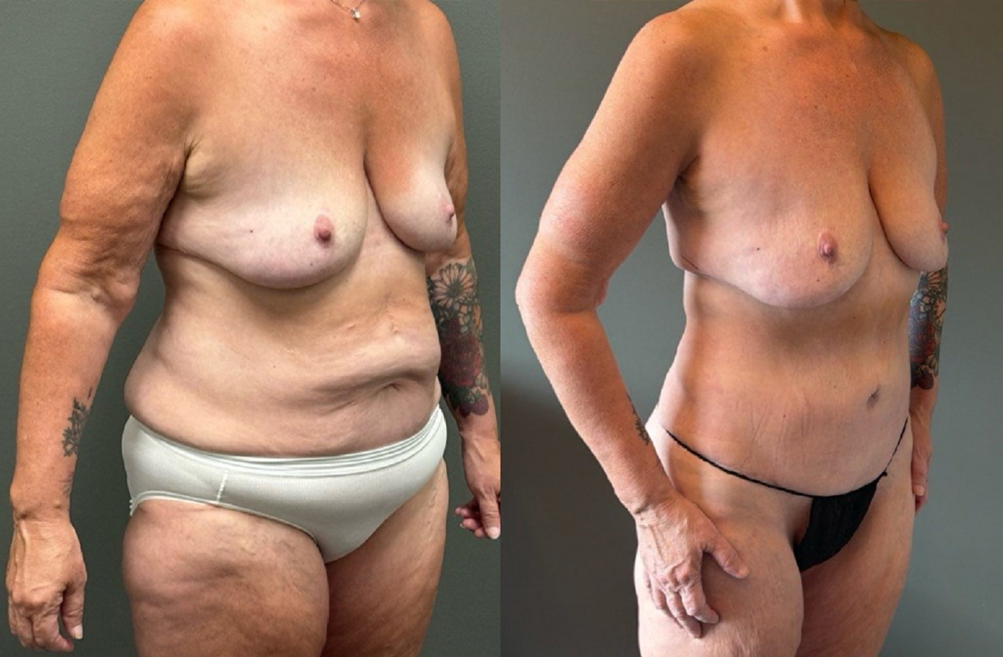 TUMMY TUCK Before & After Gallery - Patient 293566 - Image 2