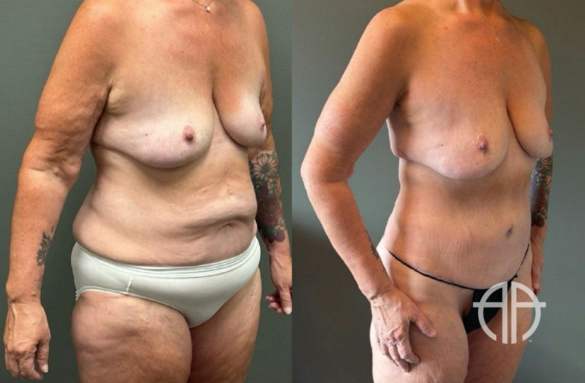 LIPOSUCTION Before & After Gallery - Patient 281568 - Image 2