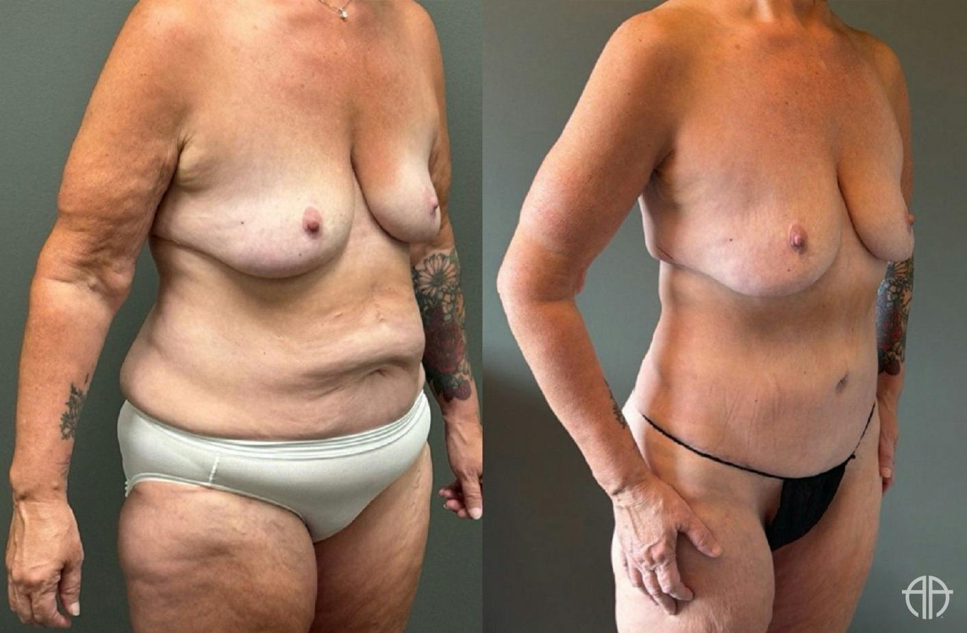 LIPOSUCTION Before & After Gallery - Patient 281568 - Image 2