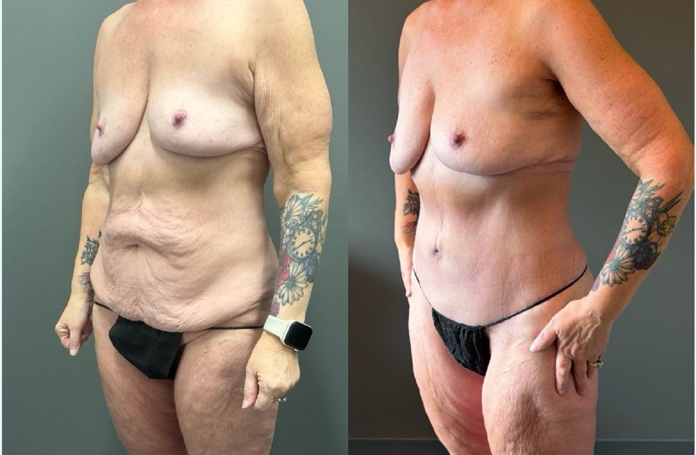 TUMMY TUCK Before & After Gallery - Patient 293566 - Image 3
