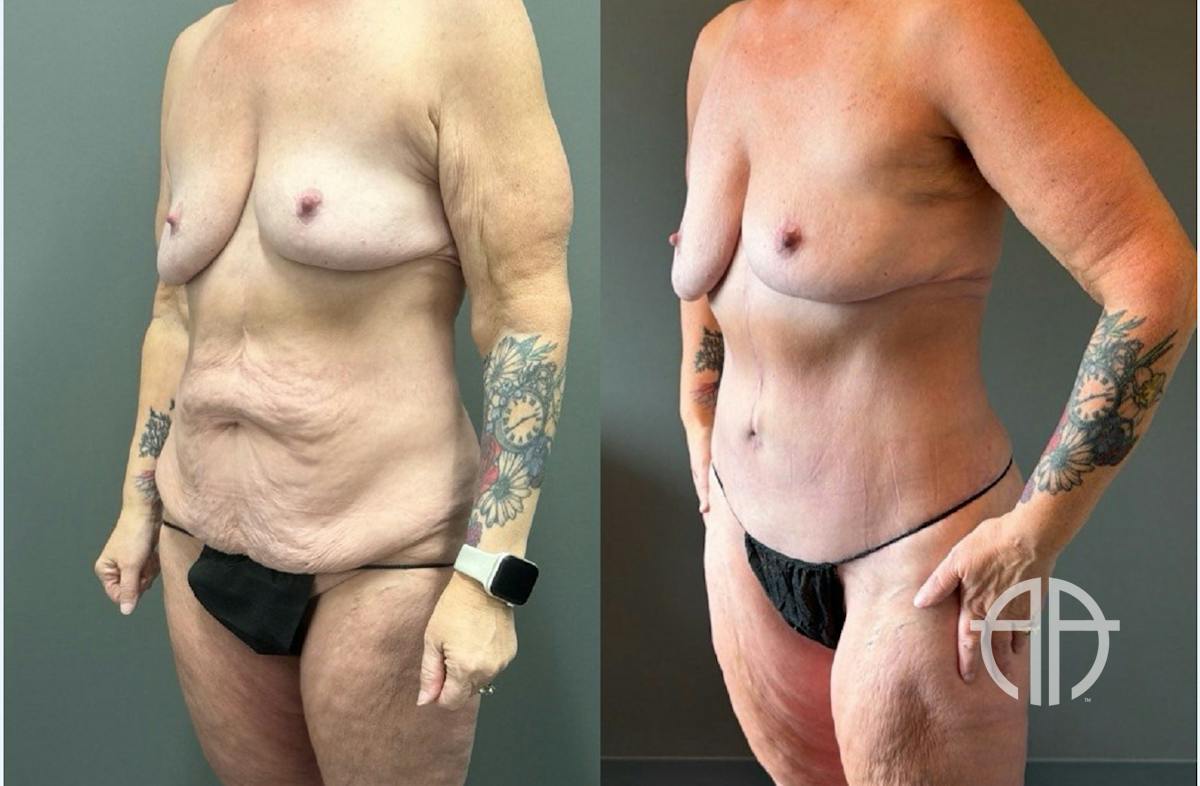 LIPOSUCTION Before & After Gallery - Patient 281568 - Image 3