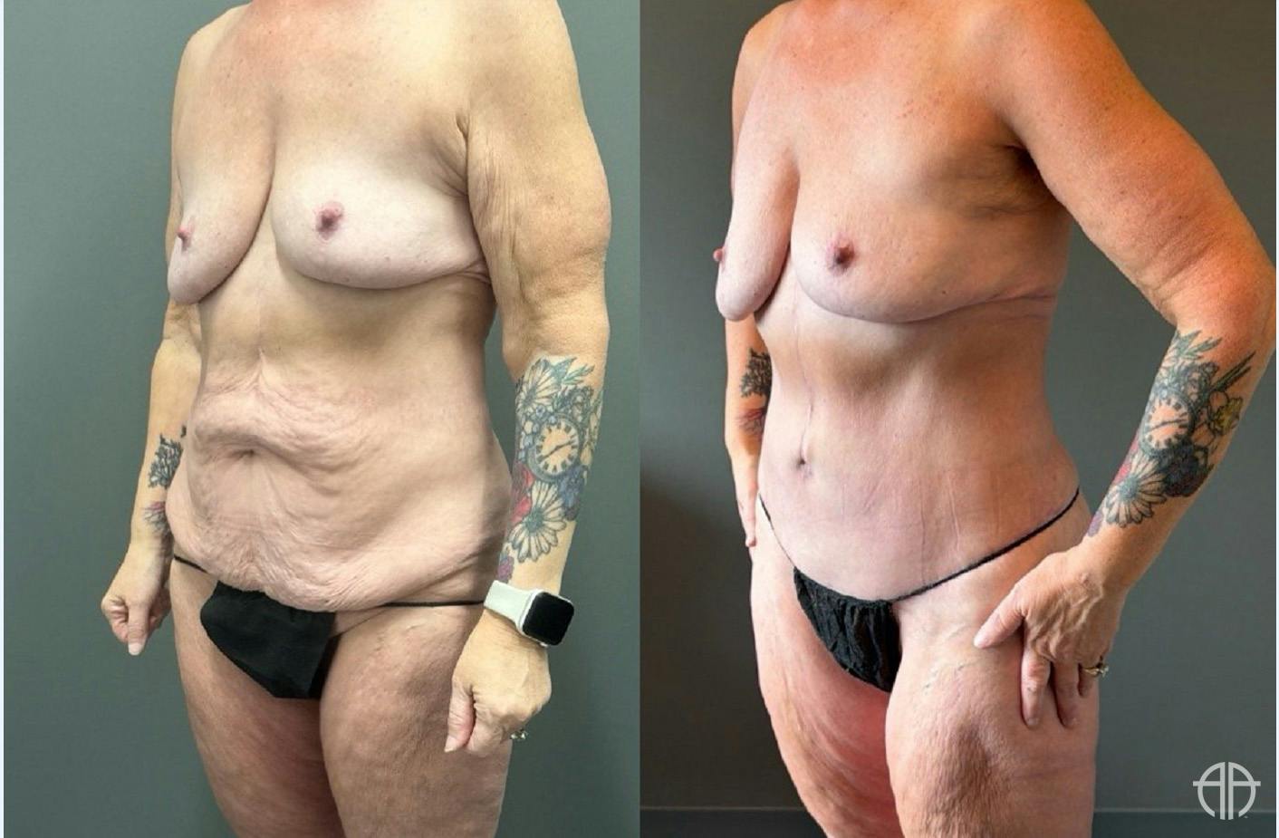 LIPOSUCTION Before & After Gallery - Patient 281568 - Image 3