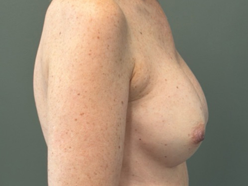 BREAST IMPLANT EXCHANGE Before & After Gallery - Patient 244658 - Image 5