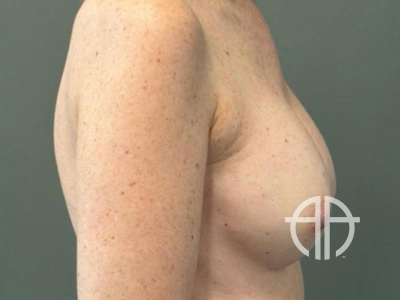 BREAST IMPLANT EXCHANGE Before & After Gallery - Patient 244658 - Image 5