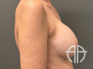 BREAST IMPLANT EXCHANGE Before & After Gallery - Patient 244658 - Image 6