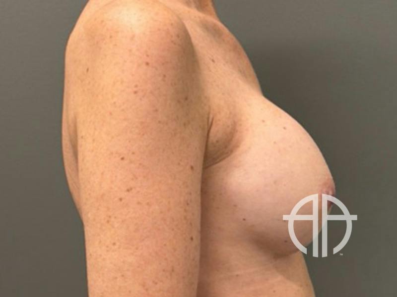 BREAST IMPLANT EXCHANGE Before & After Gallery - Patient 244658 - Image 6