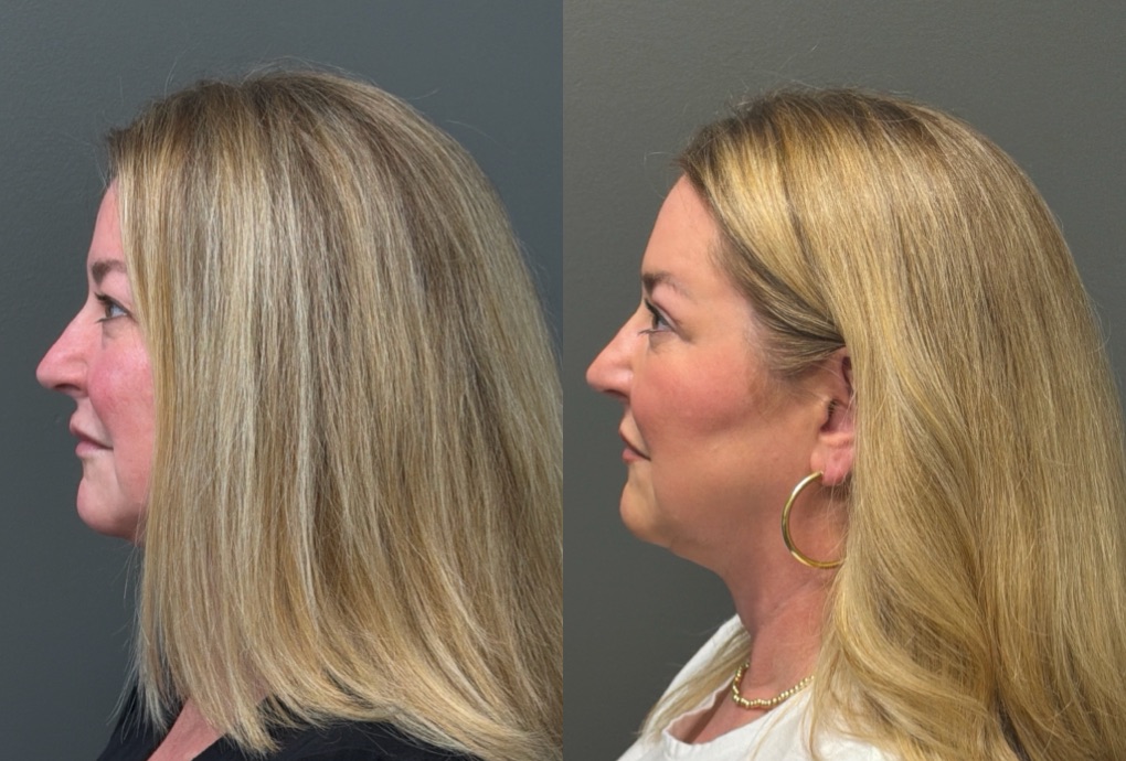THREADS Before & After Gallery - Patient 636136 - Image 3