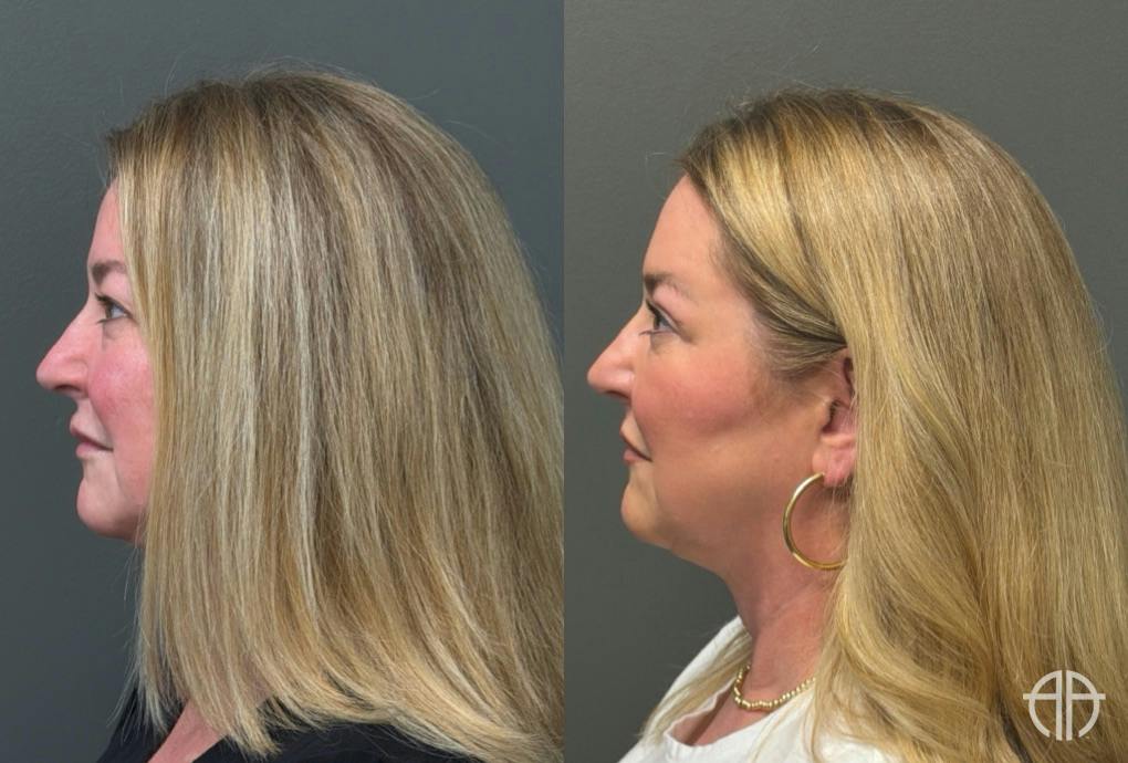 BLEPHAROPLASTY Before & After Gallery - Patient 957381 - Image 3