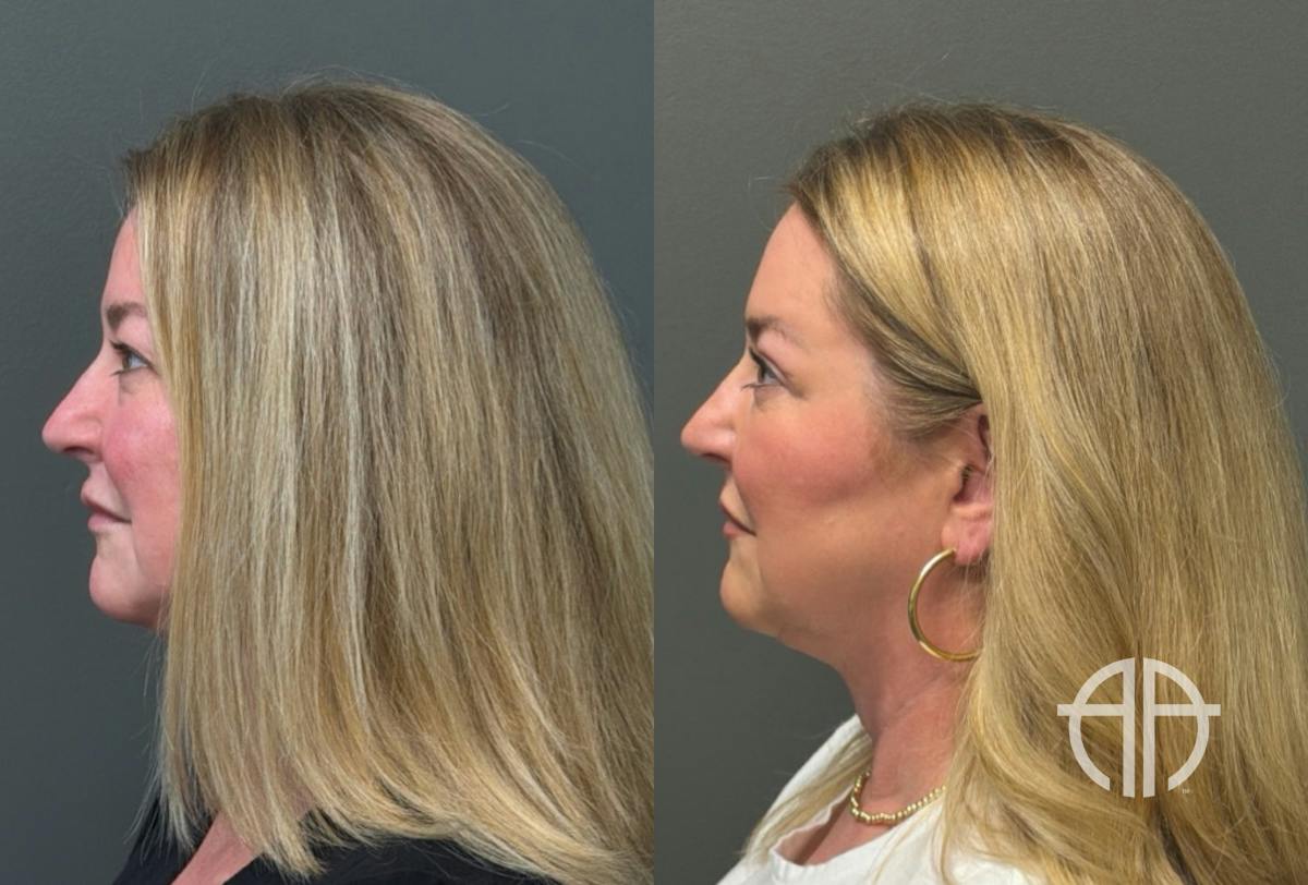 BLEPHAROPLASTY Before & After Gallery - Patient 957381 - Image 3