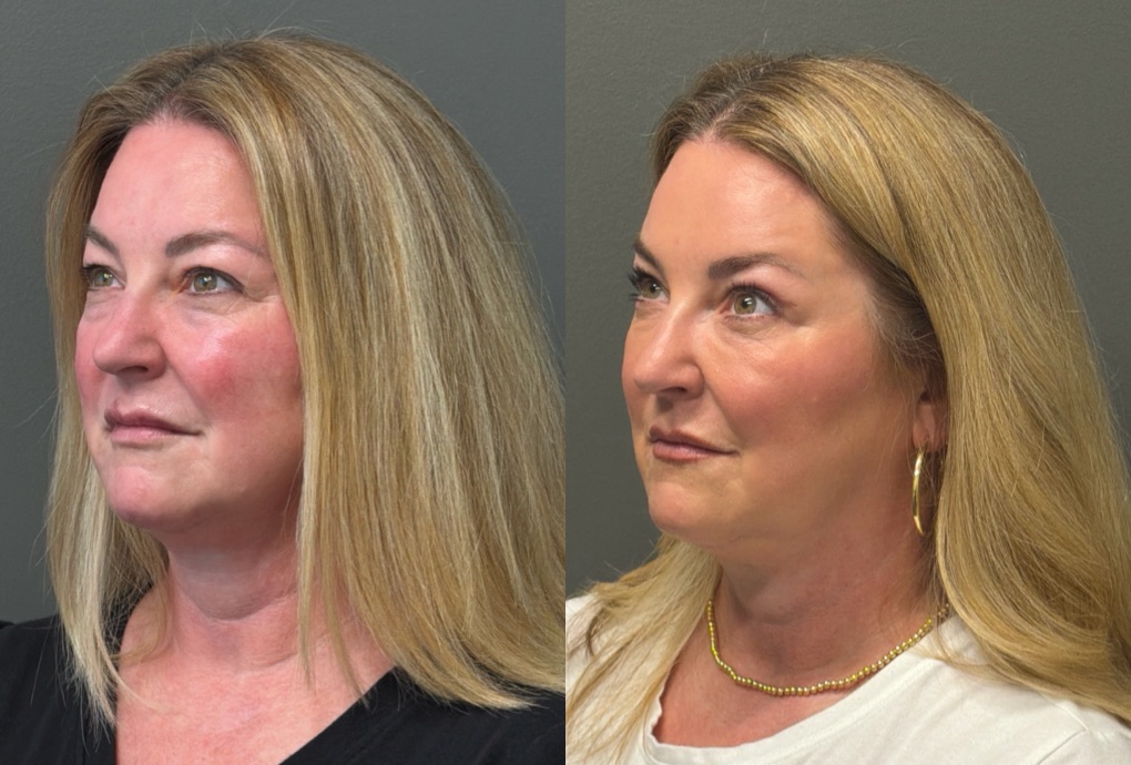 THREADS Before & After Gallery - Patient 636136 - Image 2