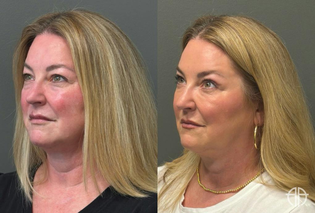 BLEPHAROPLASTY Before & After Gallery - Patient 957381 - Image 2