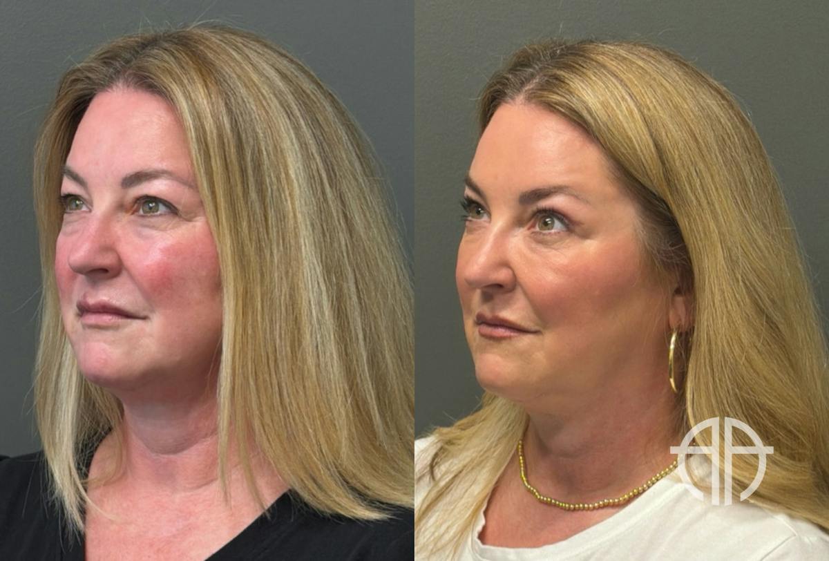 BLEPHAROPLASTY Before & After Gallery - Patient 957381 - Image 2