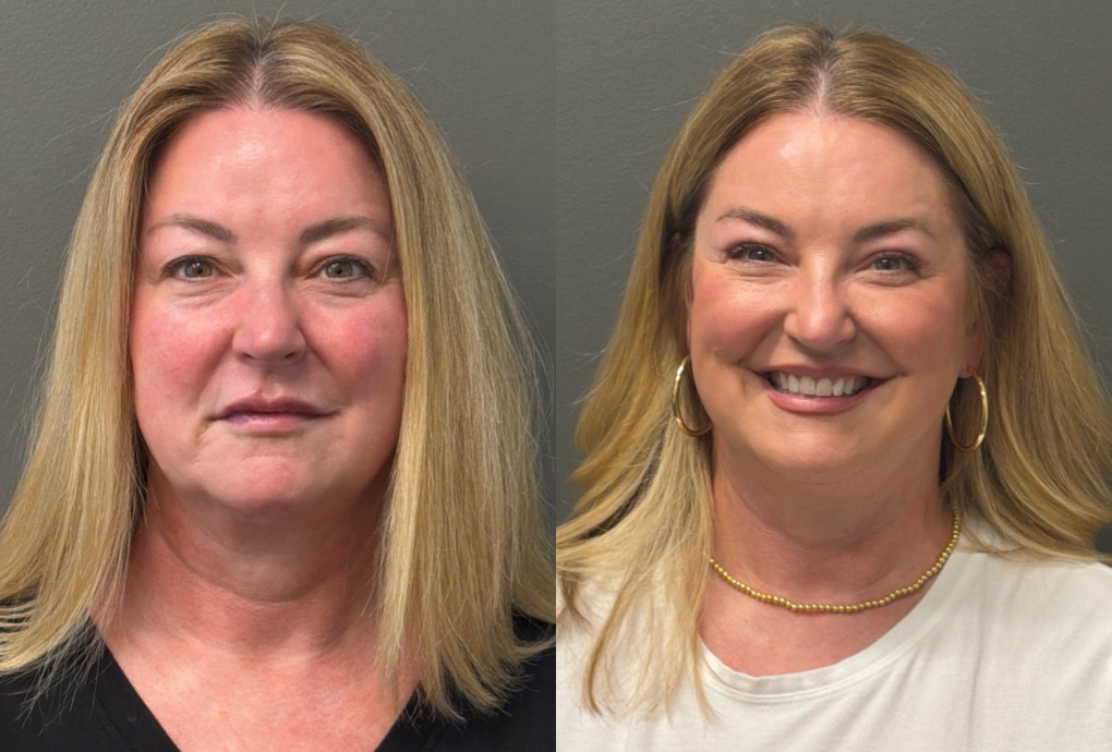THREADS Before & After Gallery - Patient 636136 - Image 1