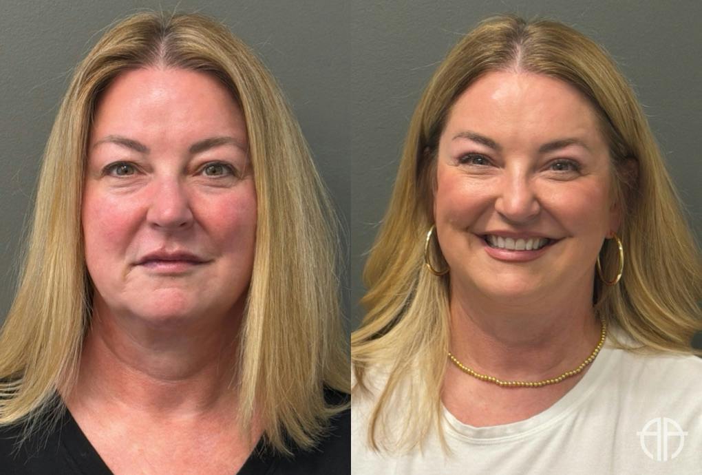 BLEPHAROPLASTY Before & After Gallery - Patient 957381 - Image 1
