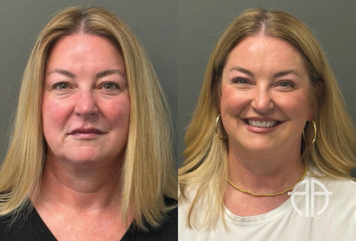 BLEPHAROPLASTY Before & After Gallery - Patient 957381 - Image 1