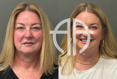 BLEPHAROPLASTY Before & After Gallery - Patient 957381 - Image 1