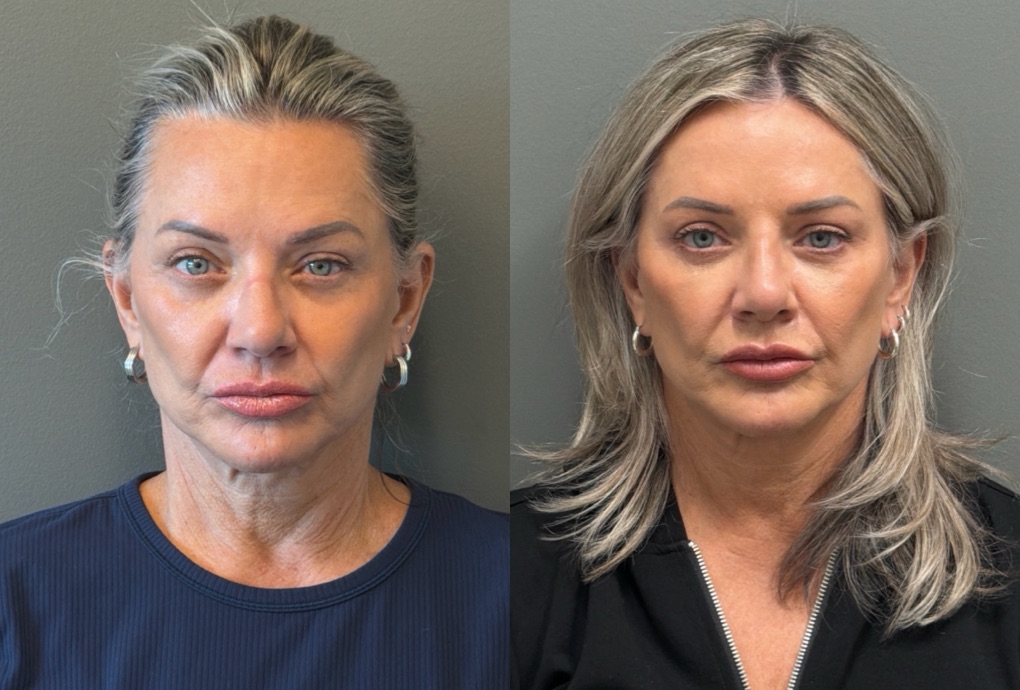 LIQUID RHINOPLASTY Before & After Gallery - Patient 953196 - Image 1