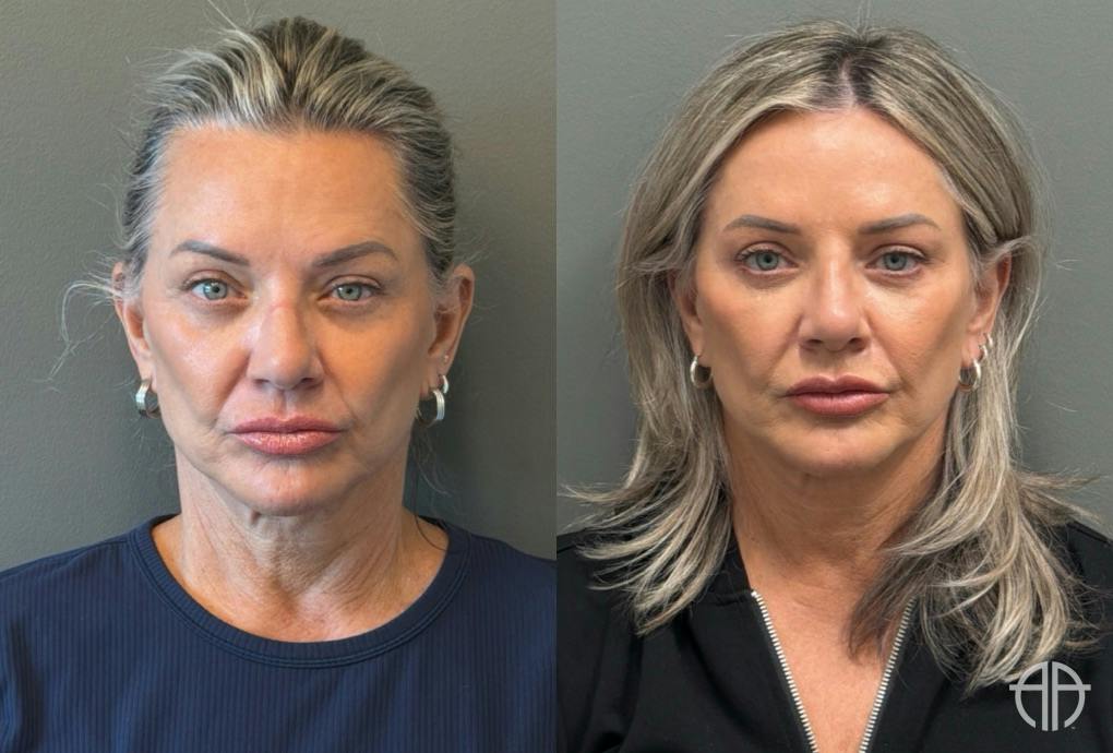 LIQUID RHINOPLASTY Before & After Gallery - Patient 953196 - Image 1