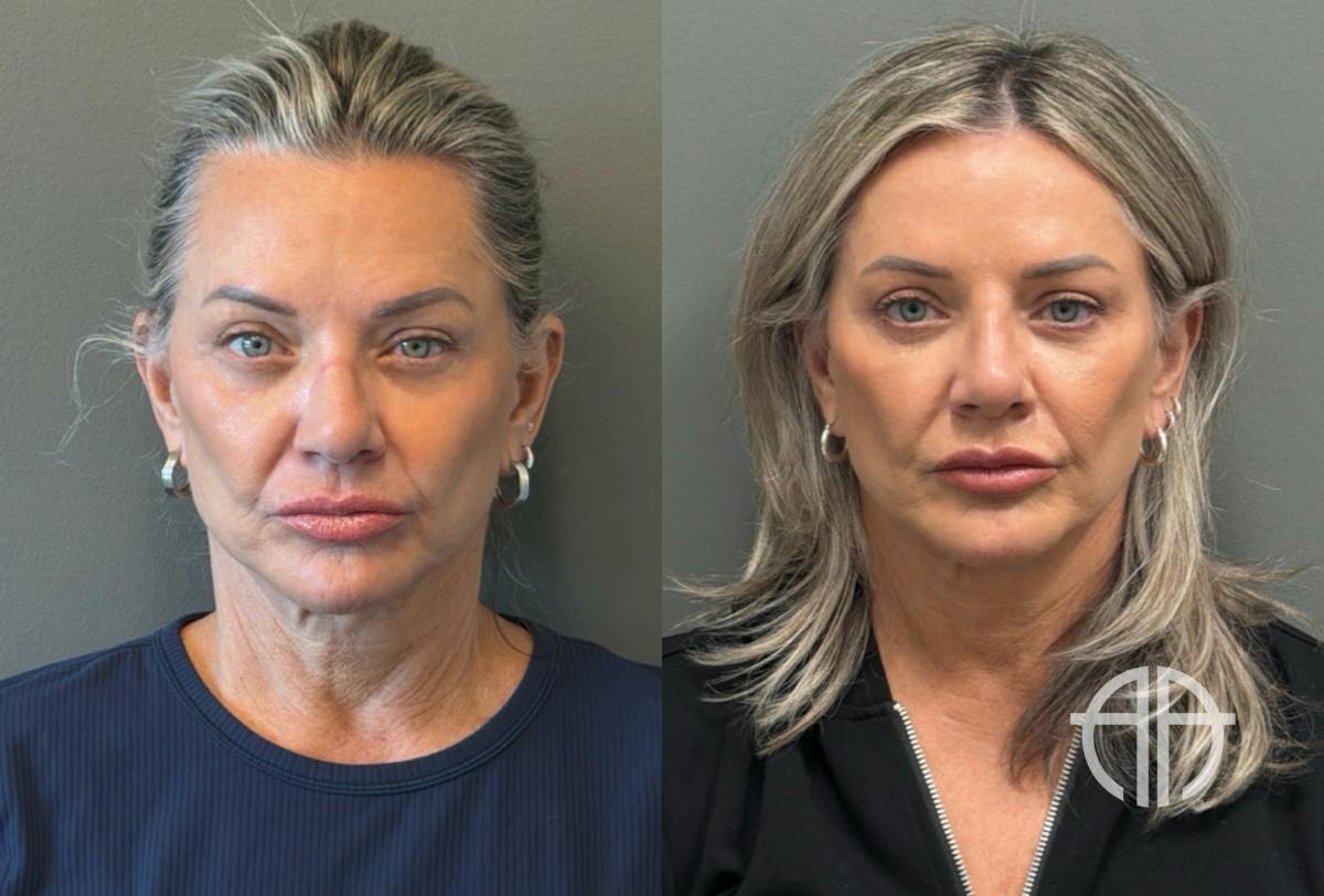 LIQUID RHINOPLASTY Before & After Gallery - Patient 953196 - Image 1
