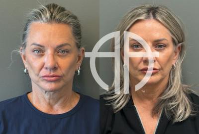 LIQUID RHINOPLASTY Before & After Gallery - Patient 953196 - Image 1