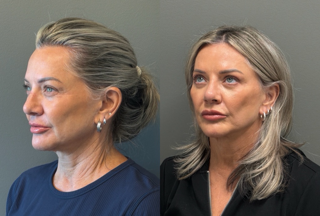 LIQUID RHINOPLASTY Before & After Gallery - Patient 953196 - Image 4