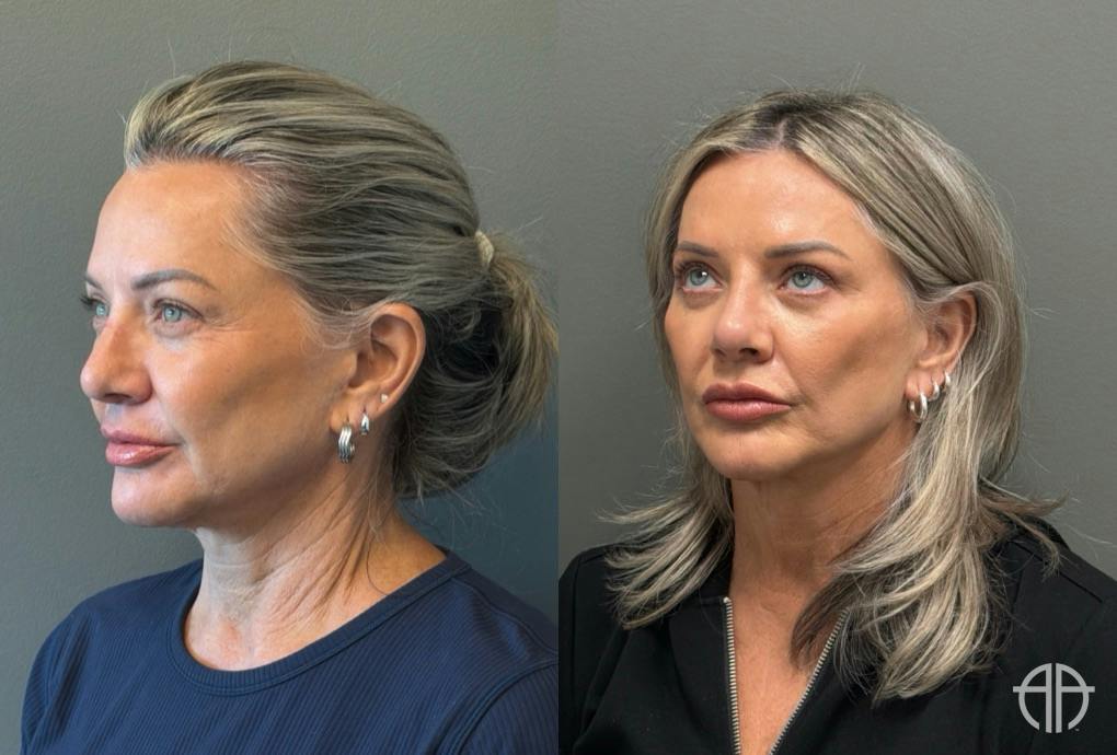 LIQUID RHINOPLASTY Before & After Gallery - Patient 953196 - Image 4