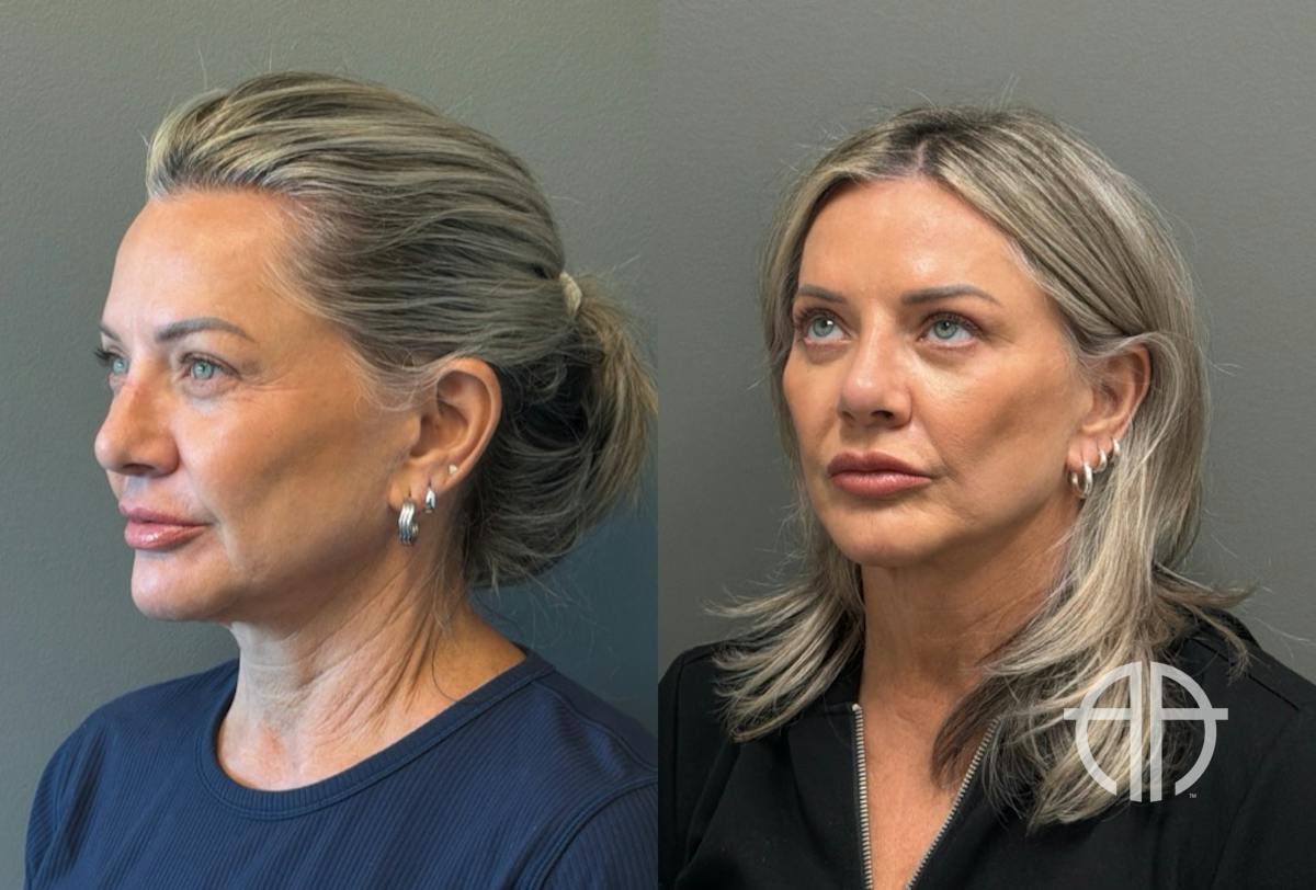 LIQUID RHINOPLASTY Before & After Gallery - Patient 953196 - Image 4