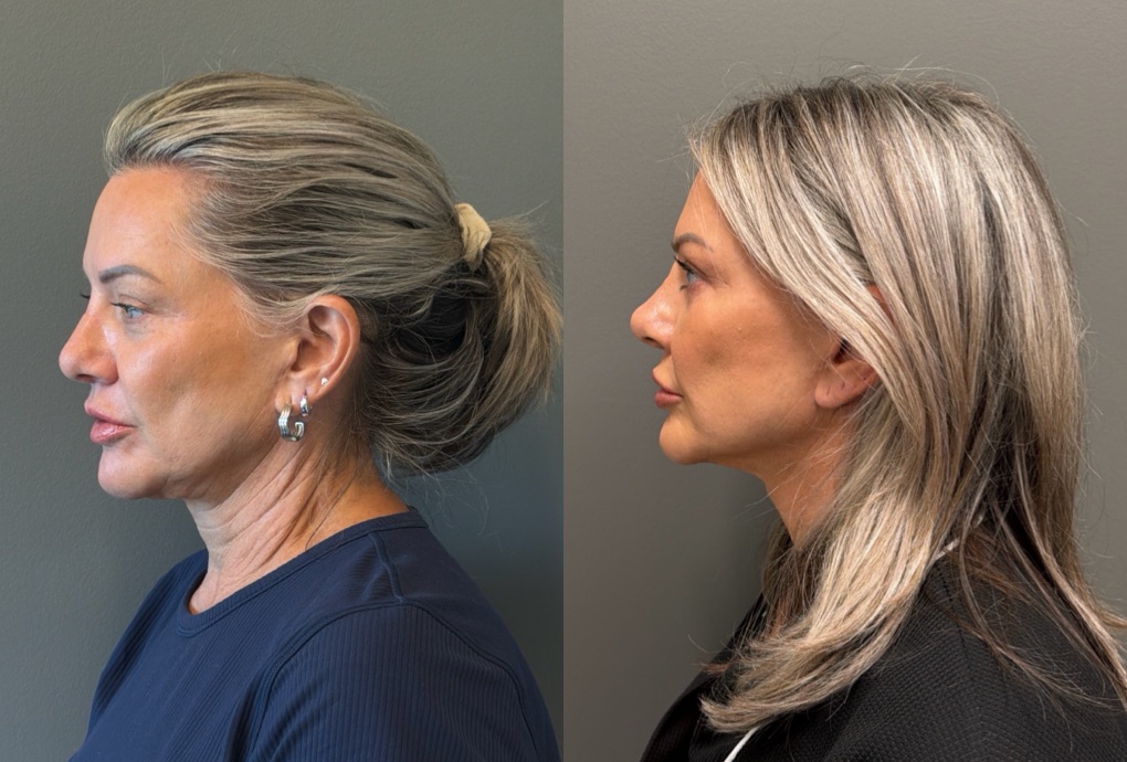 LIQUID RHINOPLASTY Before & After Gallery - Patient 953196 - Image 5