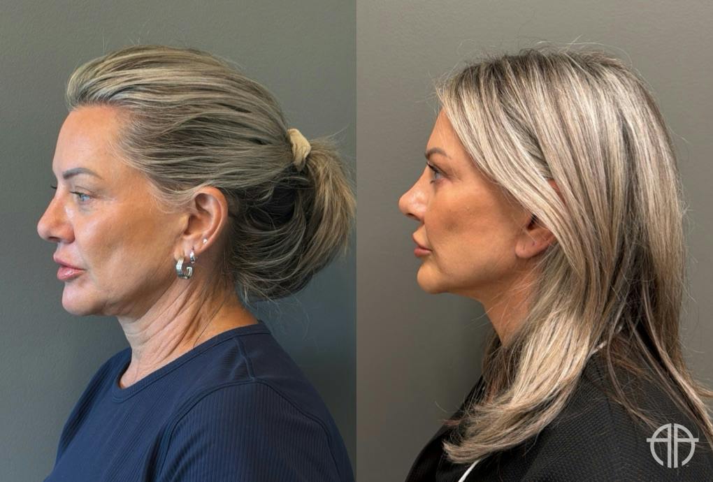 LIQUID RHINOPLASTY Before & After Gallery - Patient 953196 - Image 5