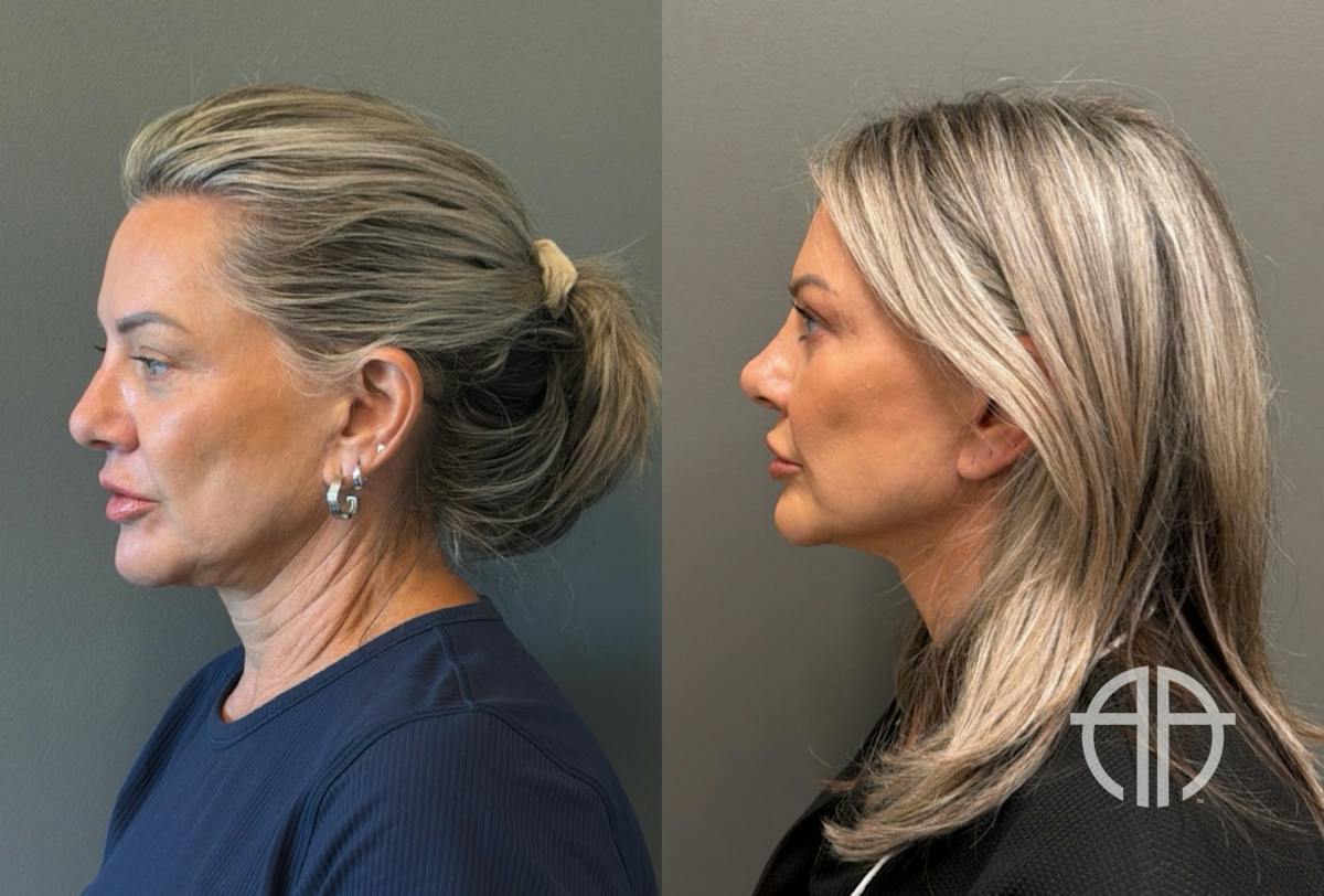 LIQUID RHINOPLASTY Before & After Gallery - Patient 953196 - Image 5