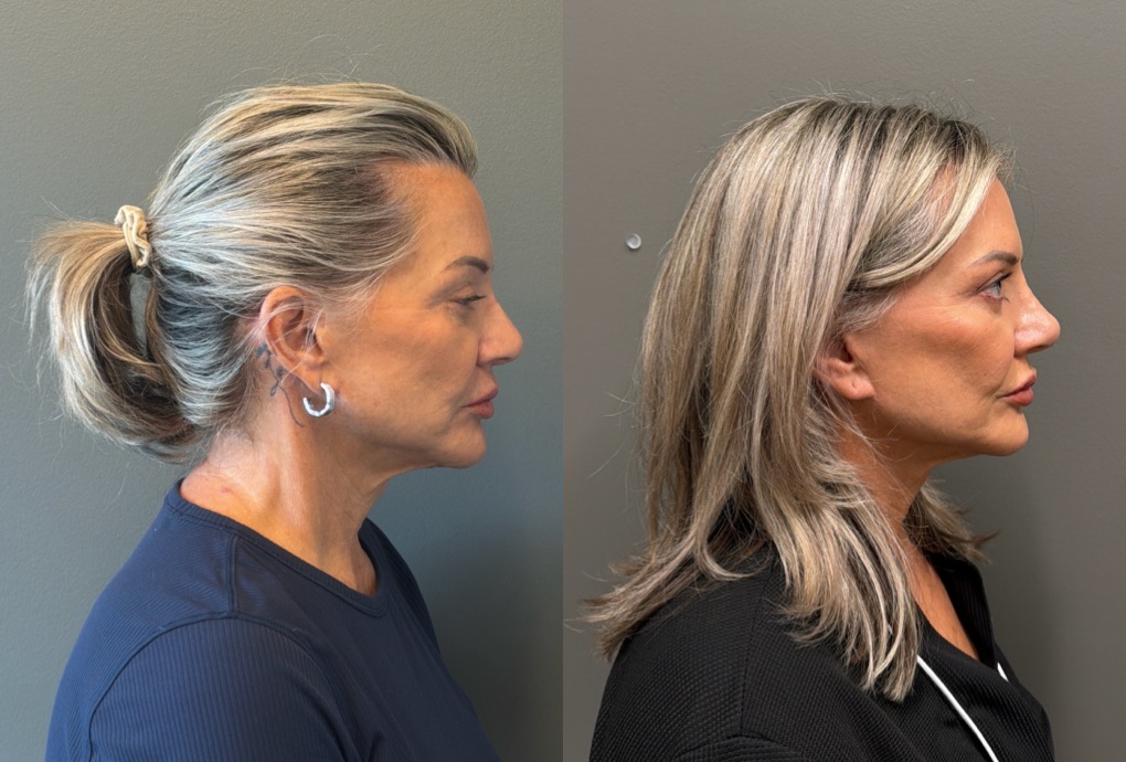 LIQUID RHINOPLASTY Before & After Gallery - Patient 953196 - Image 3