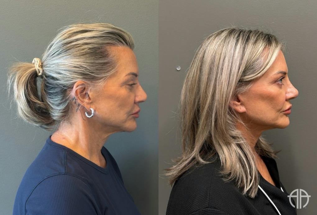 LIQUID RHINOPLASTY Before & After Gallery - Patient 953196 - Image 3
