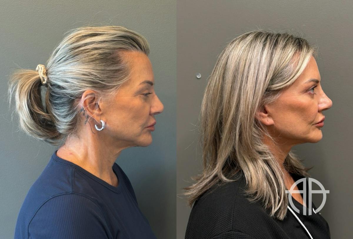 LIQUID RHINOPLASTY Before & After Gallery - Patient 953196 - Image 3