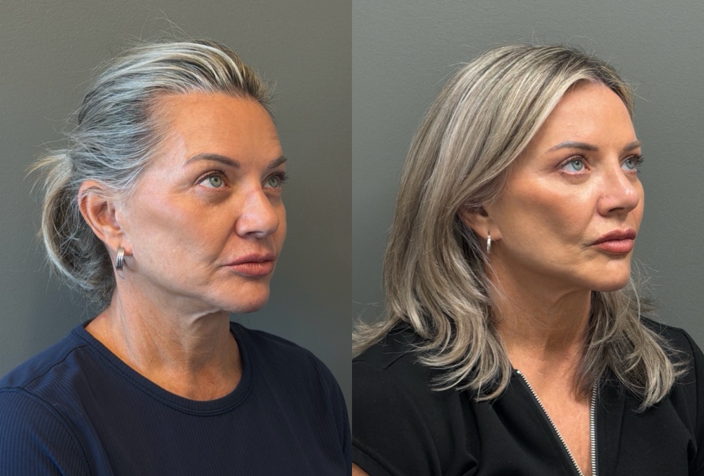 LIQUID RHINOPLASTY Before & After Gallery - Patient 953196 - Image 2
