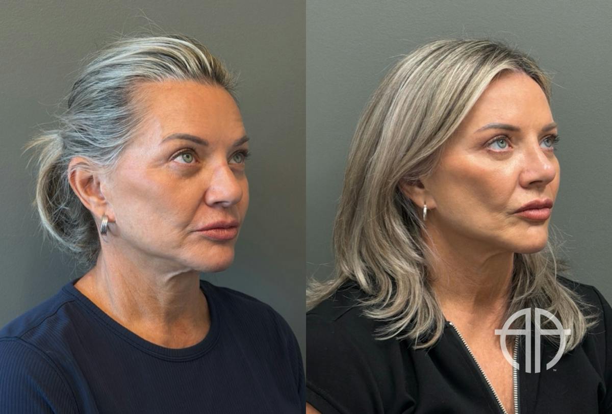 LIQUID RHINOPLASTY Before & After Gallery - Patient 953196 - Image 2