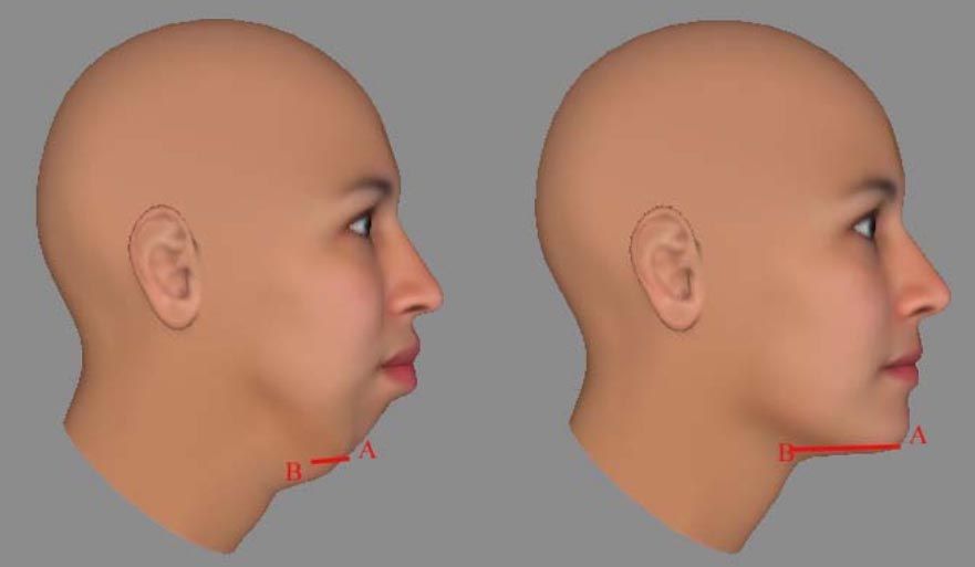 Facelift diagram 