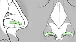 Alar Rim Graft glossary
