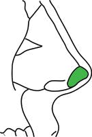 Caudal Extension Graft glossary