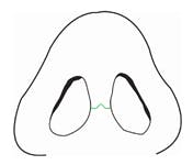 Columellar Incision glossary