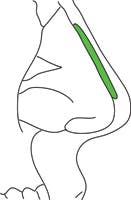 Dorsal Augmentation Graft glossary