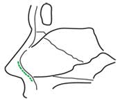 Hemitransfixion Incision glossary