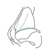 Inter Cartilaginous incision glossary
