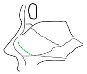 Kilian incision glossary