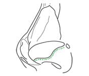 Marginal incision glossary