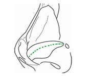 Transfixion incision glossary