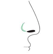 Wedge Incision glossary