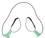 Weir incision glossary