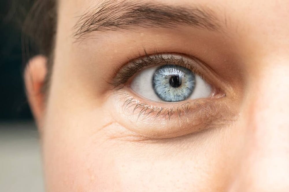 Avoid activities such as heavy lifting or strenuous exercise that put extra strain on the eyelids