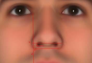 Alar Base Width (Determining Width of the Base or Bottom of the Nose)